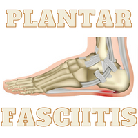 When Pain is Afoot | Plantar Fasciitis | Bunions